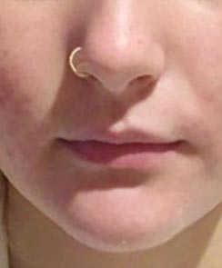 Microneedling mit Dermapen - nachher
