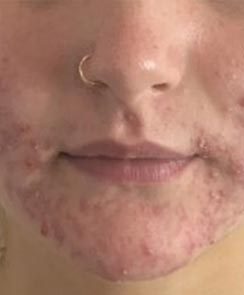 Microneedling mit Dermapen - vorher