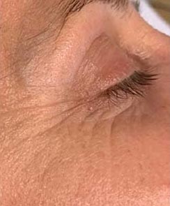 Microneedling mit Dermapen - nachher