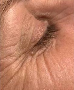 Microneedling mit Dermapen - vorher